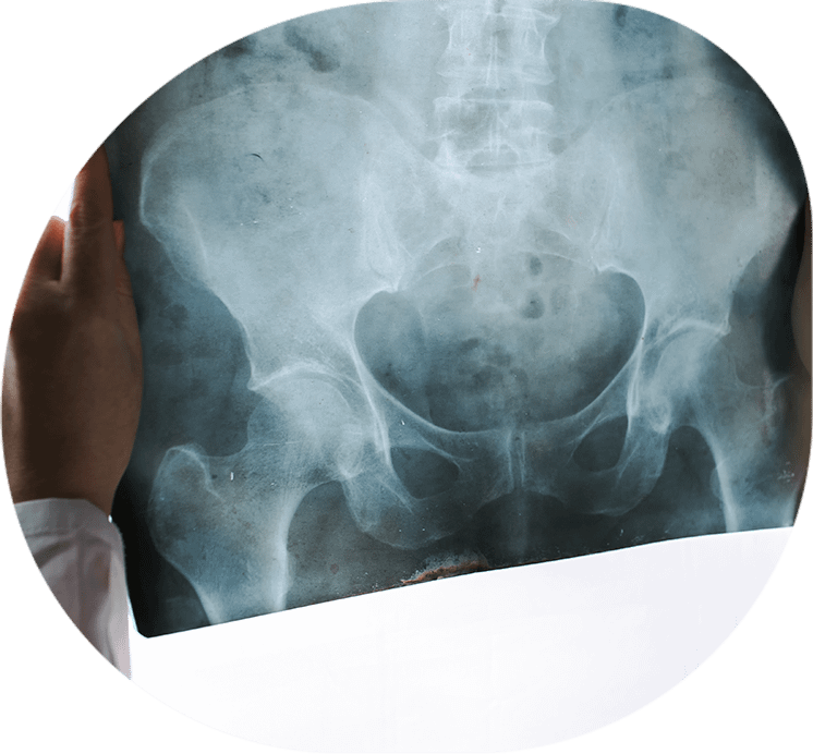 Hip Injury Compensation